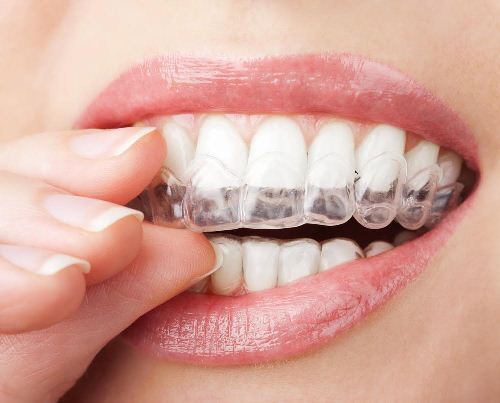 Ortodoncia invisible un método económico y de calidad que ofrece Bocanova Grupo Dental. Adiós brackets.